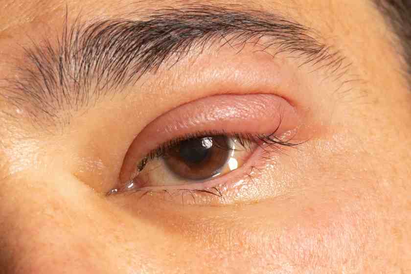 how-to-prevent-and-treat-styes-a-complete-guide