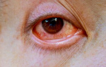 understanding-and-treating-pink-eye