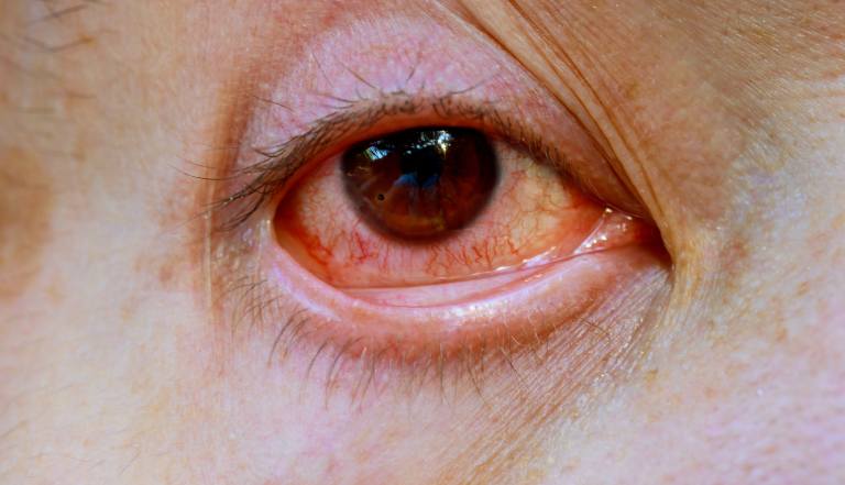 understanding-and-treating-pink-eye