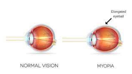myopia-clinic