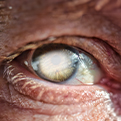 Cataract Treatment