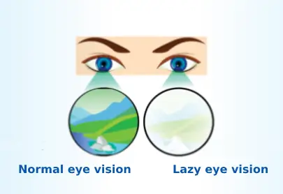 lazy-eye-symptoms