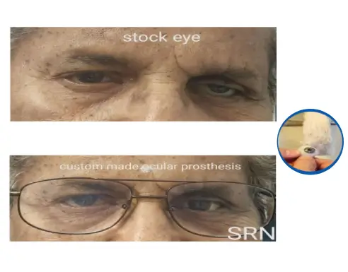 Artificial Cosmetic Eye
